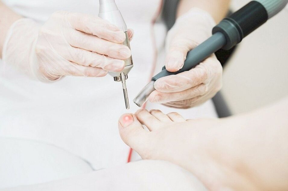 façons d'éliminer les champignons des pieds